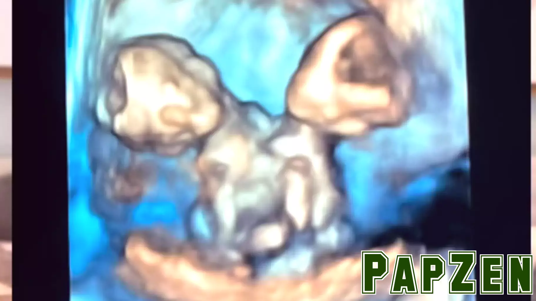 Expecting Conjoined Twin Girls: A Mother's Heartfelt Decision