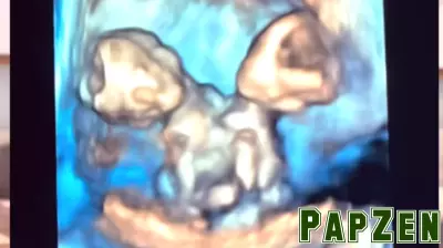 Expecting Conjoined Twin Girls: A Mother's Heartfelt Decision